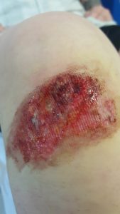 Road rash damage to Toni's skin