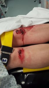 Toni's knees immediately after the accident
